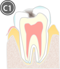 C1:歯の表面エナメル質内にできた虫歯
