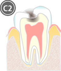 C2:象牙質にまで達した虫歯