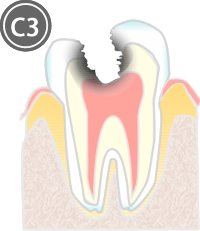 C3：歯髄（神経）にまで達した虫歯