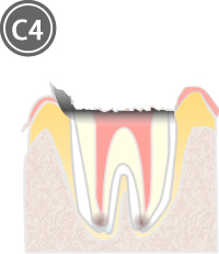 C4：歯冠がなくなった虫歯