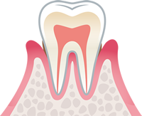 軽度歯周病