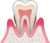 中度歯周病