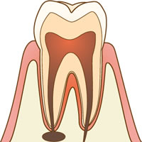 根管治療とは