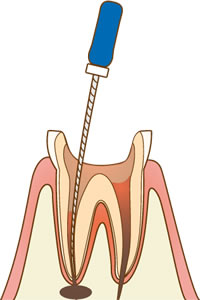 根管治療の方法