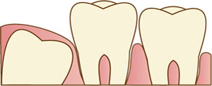 親知らずはどんな歯？